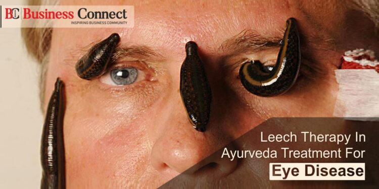Leech therapy in Ayurveda treatment for eye disease Business Connect | Best Business magazine In India