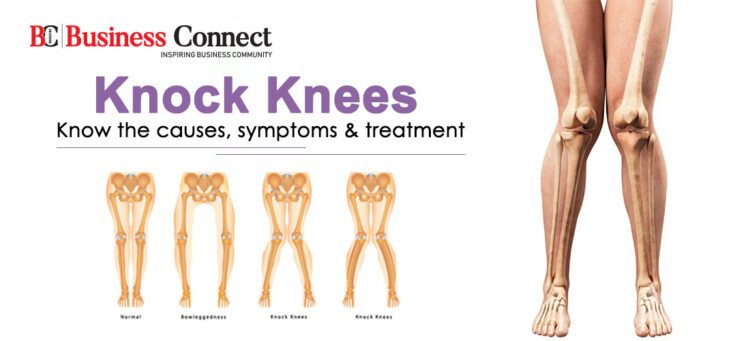 Knock Knees: Know the causes, symptoms & treatment
