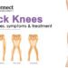 Knock Knees: Know the causes, symptoms & treatment